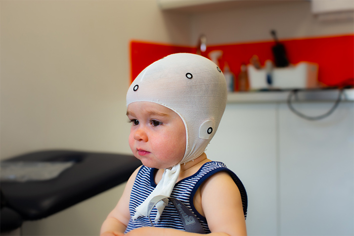 plagiocephaly-locband-lite-3d-printed-helmet-scanning-baby-1-lr