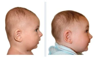 braquicefalia-con-bebe-de-4-meses
