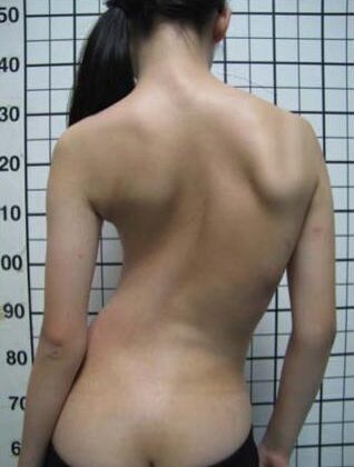 اعوجاج العمود الفقري عند المراهقين: الأسباب، الأعراض، وأحدث طرق العلاج