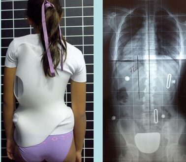 أهمية العلاج المبكر بحزام اعوجاج العمود الفقري في تحسين الانحناء وتقليل الحاجة للجراحة