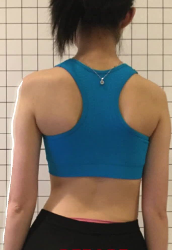 اعوجاج العمود الفقري عند البنات