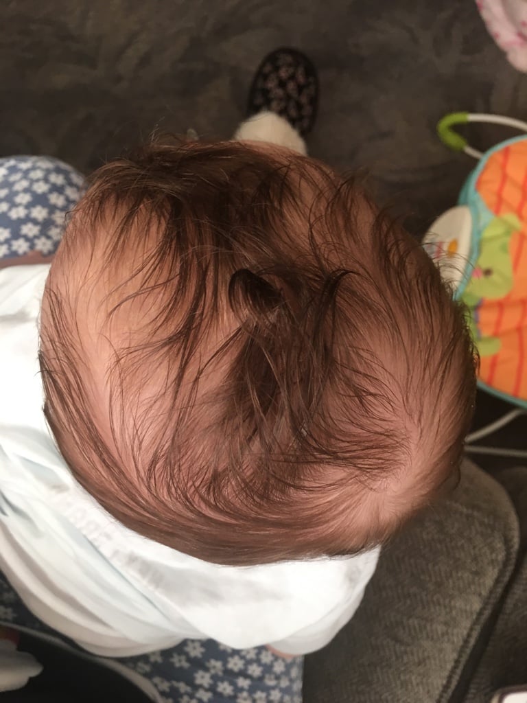 بلاجيوسيفالي وبراكي سفالي عند الأطفال