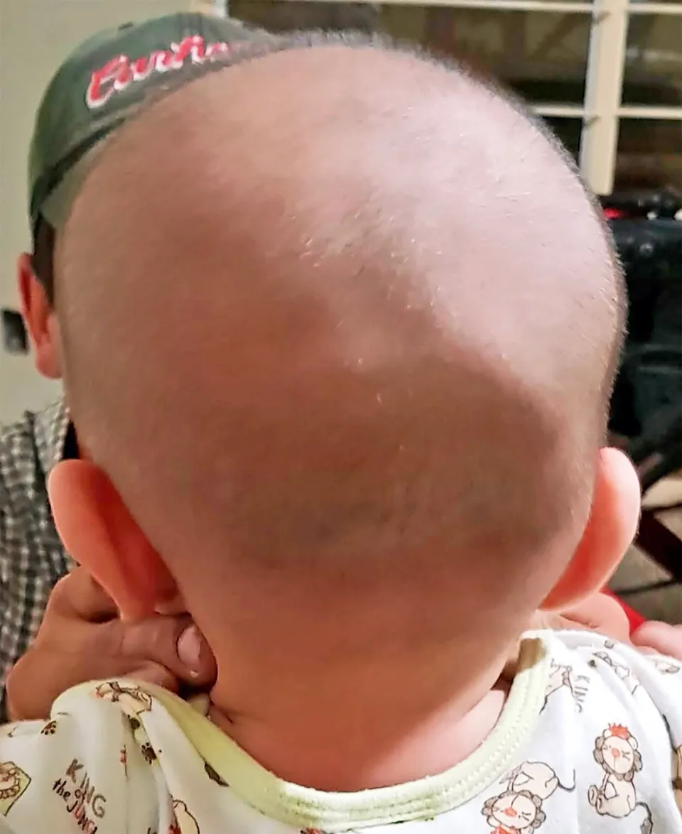 علاج شكل رأس الطفل غير طبيعي