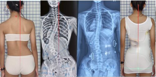 حزام اعوجاج العمود الفقري