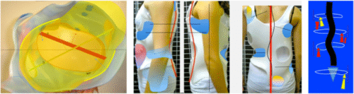 حزام اعوجاج العمود الفقري