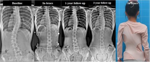 آخر عمر لاستخدام حزام اعوجاج العمود الفقري