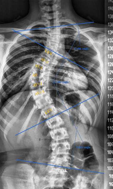 ما هو شكل ألم اعوجاج العمود الفقري؟