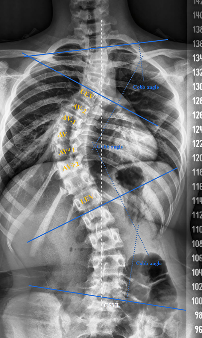 ما هو شكل ألم اعوجاج العمود الفقري؟