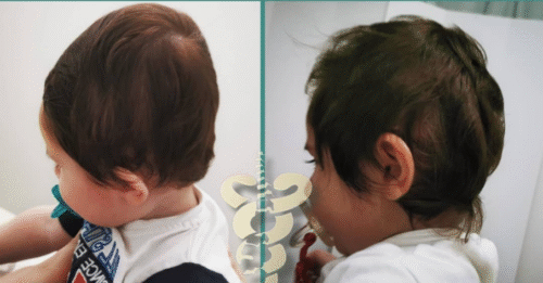 تسطّح رأس الطفل