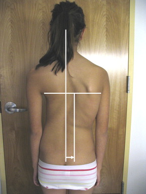 اعوجاج العمود الفقري 