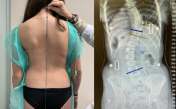 كيف تتوقع تطور اعوجاج العمود الفقري بدقة؟