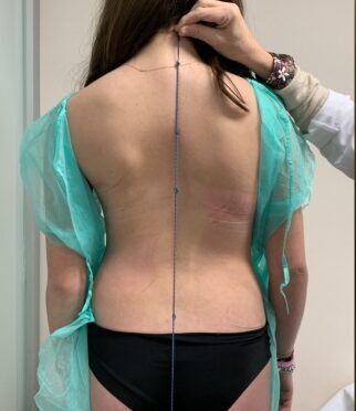 كيف تتوقع تطور اعوجاج العمود الفقري بدقة؟