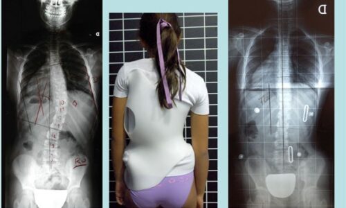 حزام اعوجاج العمود الفقري