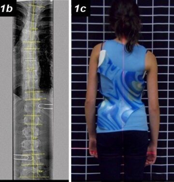 هل حزام اعوجاج العمود الفقري مناسب لكل الحالات؟ ومتى لا يكون الخيار الصحيح؟