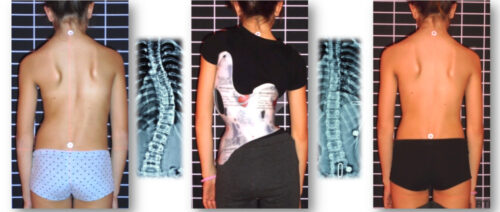 ما هو حزام اعوجاج العمود الفقري ولماذا يُستخدم؟