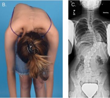 هل يؤثر اعوجاج العمود الفقري على العمر؟ كم يمكن للشخص أن يعيش مع الاعوجاج؟