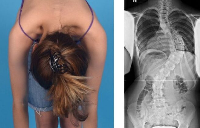 هل يؤثر اعوجاج العمود الفقري على العمر؟ كم يمكن للشخص أن يعيش مع الاعوجاج؟