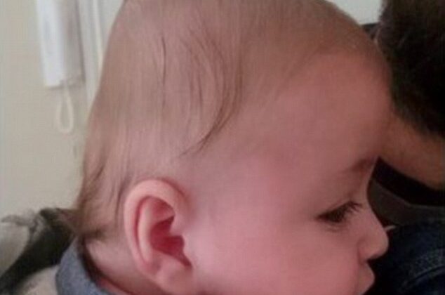 متى يصبح علاج متلازمة تسطح الرأس متأخرًا؟