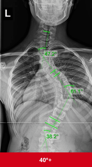 هل يؤثر اعوجاج العمود الفقري على القلب؟ دليلك لفهم الأعراض والمخاطر