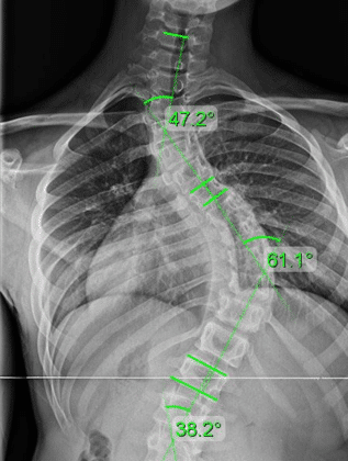 علاج اعوجاج العمود الفقري