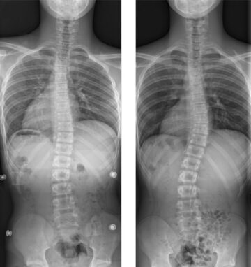 أحدث الأبحاث حول علاج اعوجاج العمود الفقري