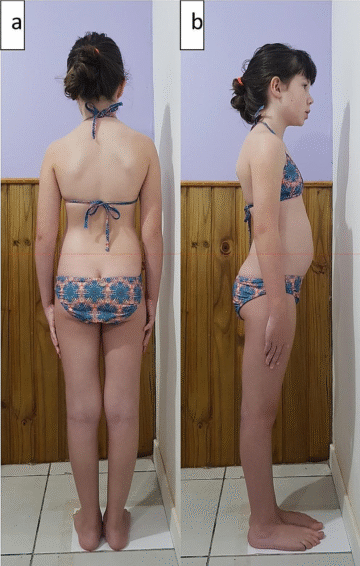 هل يمكن أن يسبب اعوجاج العمود الفقري بروز البطن؟ الحقيقة العلمية للأهل والمرضى