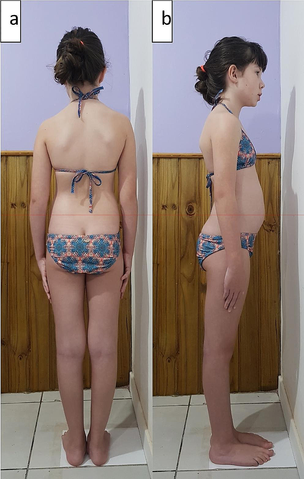 هل يمكن أن يسبب اعوجاج العمود الفقري بروز البطن؟ الحقيقة العلمية للأهل والمرضى