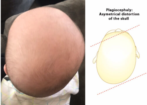 متى يجب القلق بشأن جمجمة الطفل؟