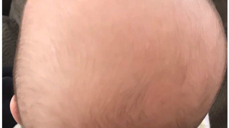 متى يجب القلق بشأن جمجمة الطفل؟