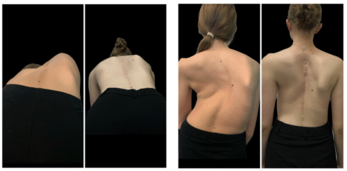 المرحلة الأخيرة من اعوجاج العمود الفقري