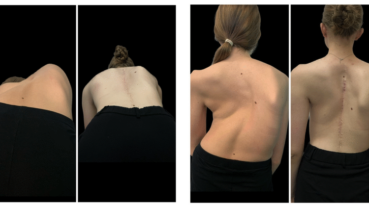 ما الحالات التي يمكن أن تُخطئ على أنها اعوجاج العمود الفقري؟ وأسبابها