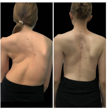 ما الحالات التي يمكن أن تُخطئ على أنها اعوجاج العمود الفقري؟ وأسبابها