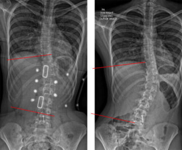 لماذا يختلف علاج اعوجاج العمود الفقري من شخص لآخر؟
