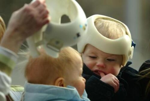 خوذة علاج الرأس المسطّح