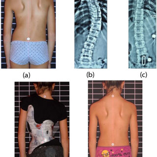 كيف تختار حزام اعوجاج العمود الفقري المناسب