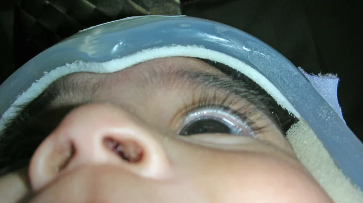 ماذا يحدث عند حدوث خطأ في تصنيع أو تصميم خوذة علاج الرأس المسطّح؟