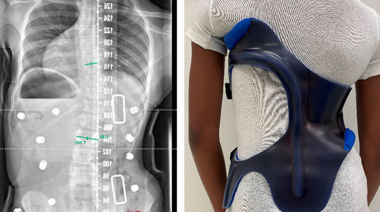 ما الذي قد يفسد نتائج حزام اعوجاج العمود الفقري؟ أخطاء شائعة