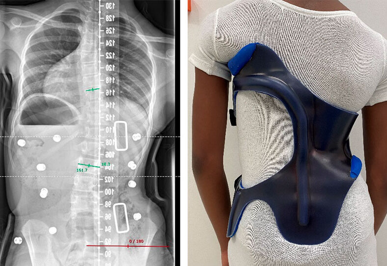 ما الذي قد يفسد نتائج حزام اعوجاج العمود الفقري؟ أخطاء شائعة