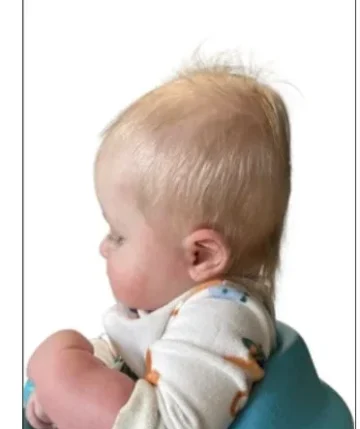 هل سيتعدل شكل رأس طفلك تلقائيًا أم يحتاج لتقييم طبي؟ دليل الأهل للمتابعة الصحيحة