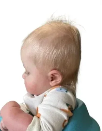 هل سيتعدل شكل رأس طفلك تلقائيًا أم يحتاج لتقييم طبي؟ دليل الأهل للمتابعة الصحيحة