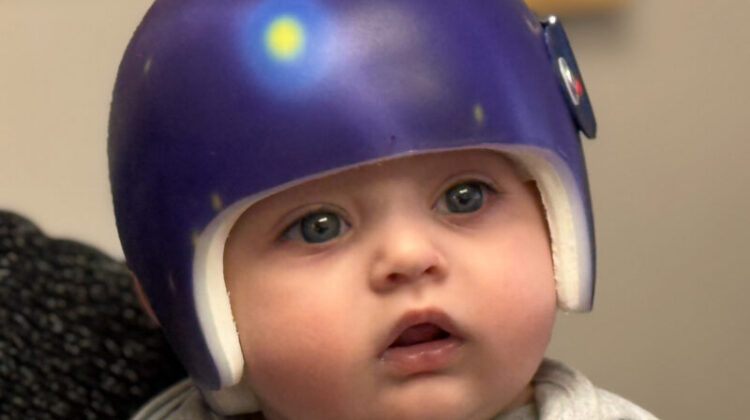 ما معنى تصميم خوذة علاج الرأس المسطح