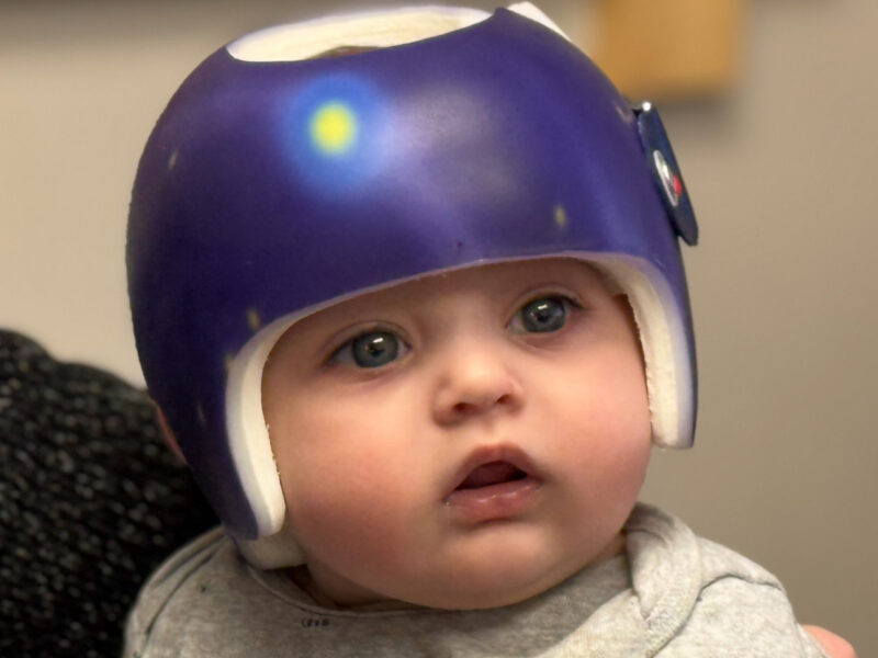 خوذة علاج الرأس المسطح: لماذا يختلف شكلها ومدة استخدامها من طفل لآخر؟