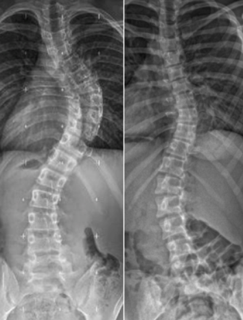 ماذا يحدث في الجسم عند الإصابة باعوجاج العمود الفقري؟