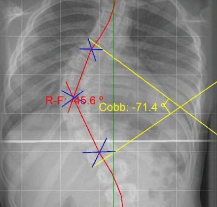 متى نحكم أن اعوجاج العمود الفقري دخل مرحلة الخطر؟