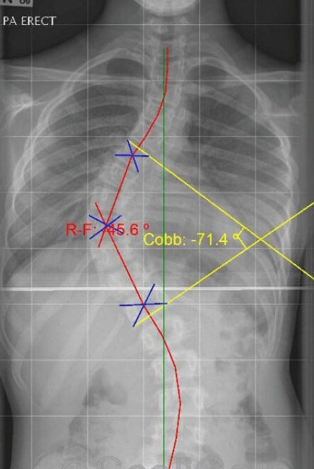 متى نحكم أن اعوجاج العمود الفقري دخل مرحلة الخطر؟