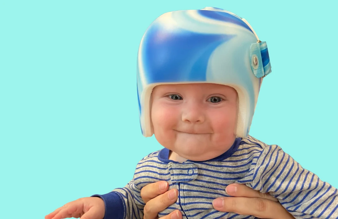 علامات تدل على أن خوذة علاج الرأس المسطّح لن تنجح: كيف تعرف فاعليتها قبل فوات الأوان؟