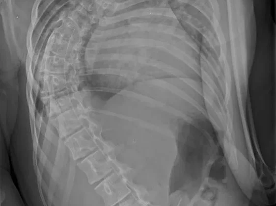 ما هي أسوأ أنواع اعوجاج العمود الفقري؟