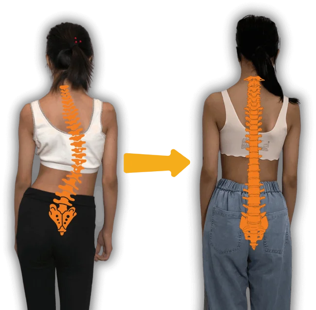 أفضل نمط حياة لمريض اعوجاج العمود الفقري