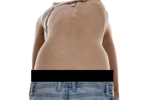 كيف تعرف علامات اعوجاج العمود الفقري غير الطبيعية؟