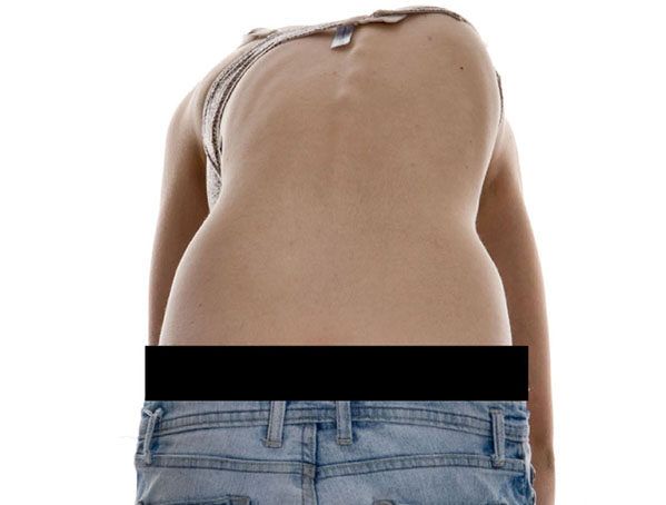 كيف تعرف علامات اعوجاج العمود الفقري غير الطبيعية؟